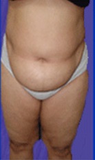 abdominoplasty before