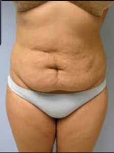 Abdominoplasty before