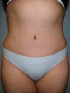 Abdominoplasty before