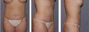 tummy tuck surgey after