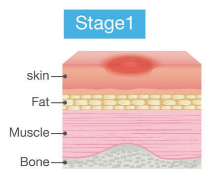 bedsore stage1