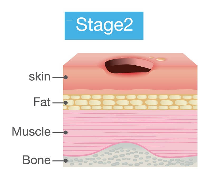 bedsore stage2