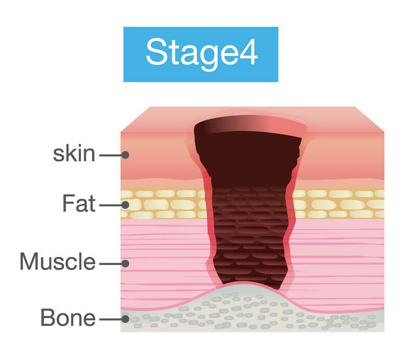 stage4